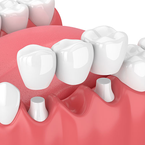 traditional dental bridges in Brampton offered