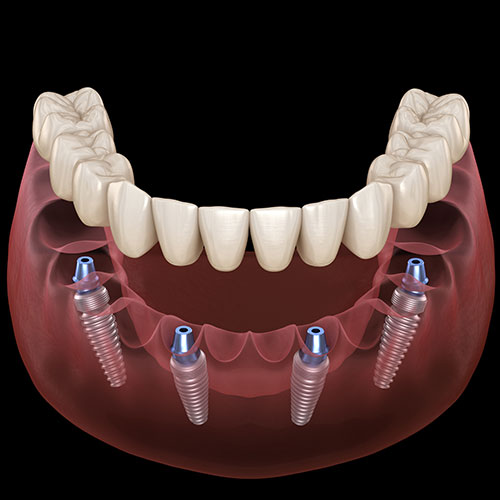 jawbone structure with all on four dental implant