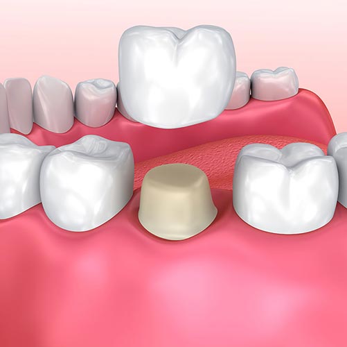 structure dental crown at Brampton dental clinic