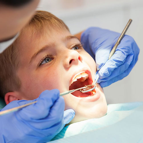 dental fillings at tridont dental