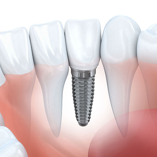 jawbone structure with an implant in a tooth